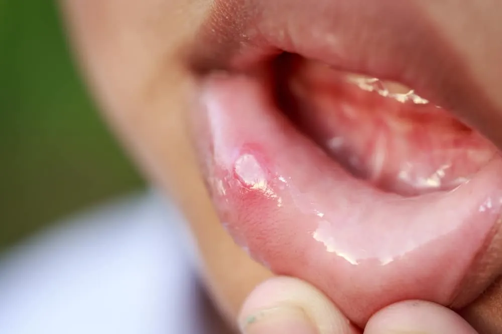 Comment traiter les aphtes ?